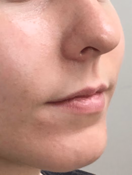 Filler before and after, case 17301 - Cool Springs Plastic Surgery