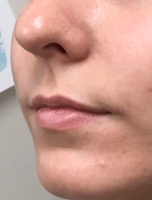 Filler before and after, case 17301 - Cool Springs Plastic Surgery