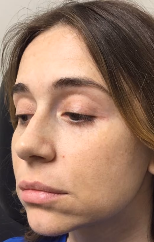 Filler before and after, case 17377 - Cool Springs Plastic Surgery