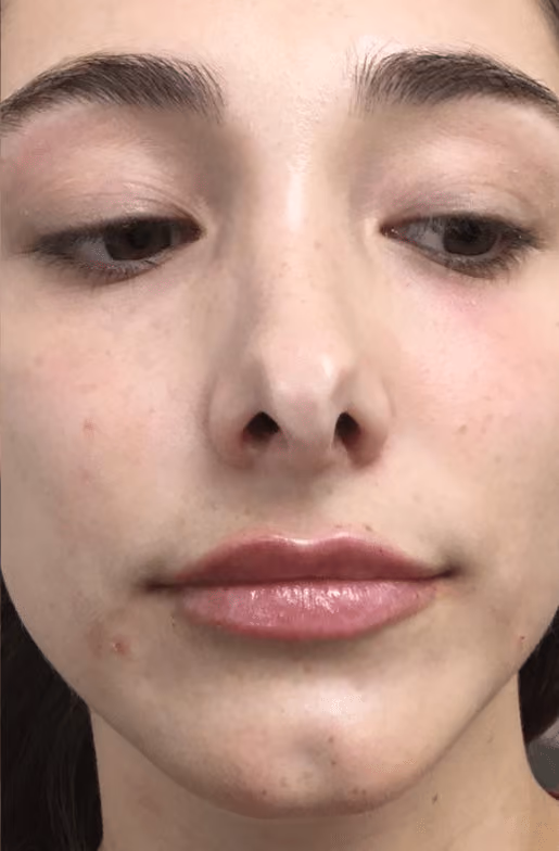 Filler before and after, case 17393 - Cool Springs Plastic Surgery
