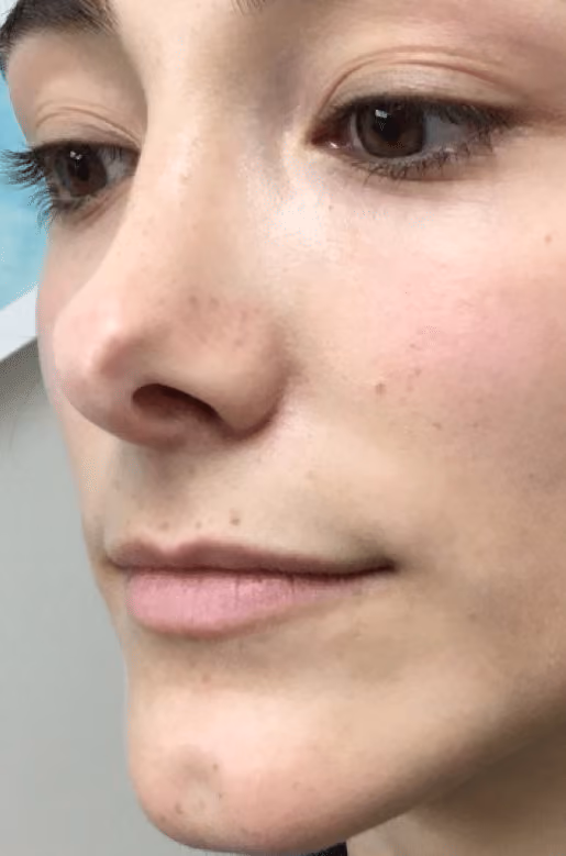 Filler before and after, case 17393 - Cool Springs Plastic Surgery