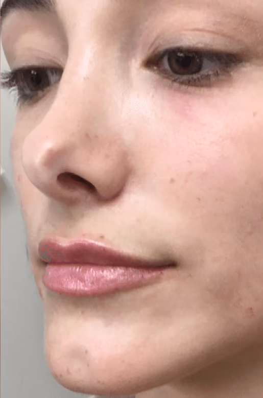 Filler before and after, case 17393 - Cool Springs Plastic Surgery