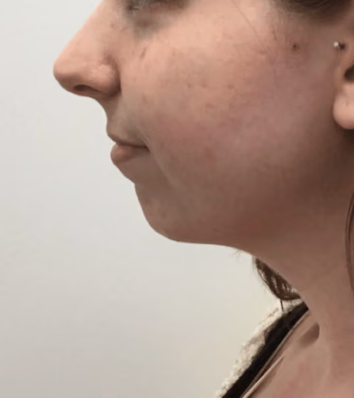 Filler before and after, case 17415 - Cool Springs Plastic Surgery
