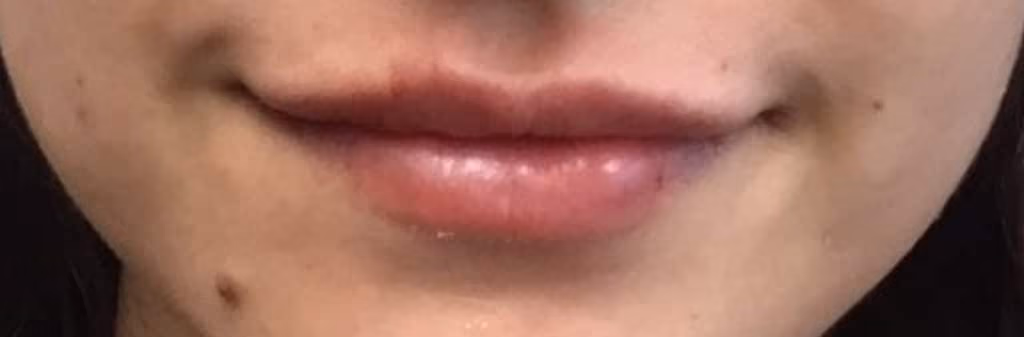 Filler before and after, case 18625 - Cool Springs Plastic Surgery