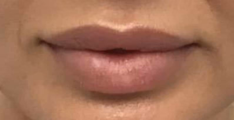 Filler before and after, case 18633 - Cool Springs Plastic Surgery