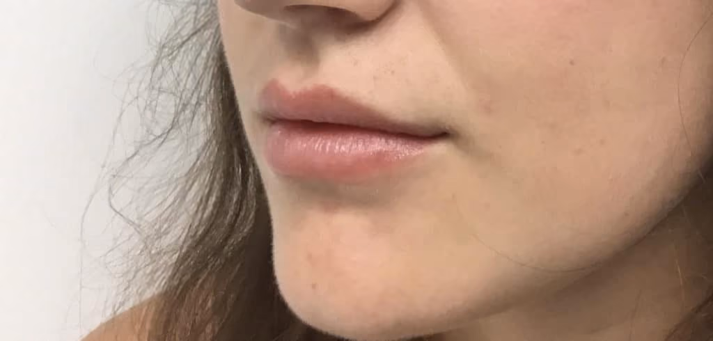 Filler before and after, case 18643 - Cool Springs Plastic Surgery