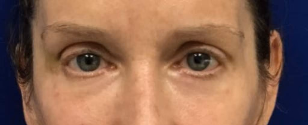 Filler before and after, case 18673 - Cool Springs Plastic Surgery