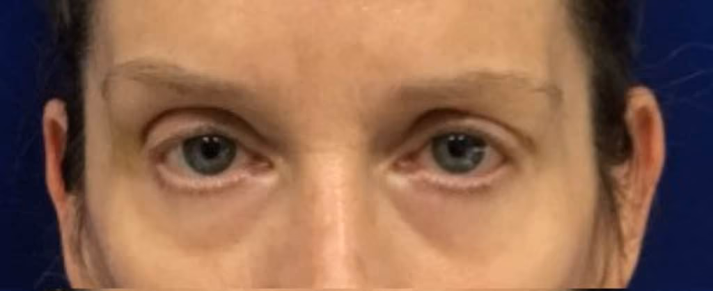 Filler before and after, case 18673 - Cool Springs Plastic Surgery