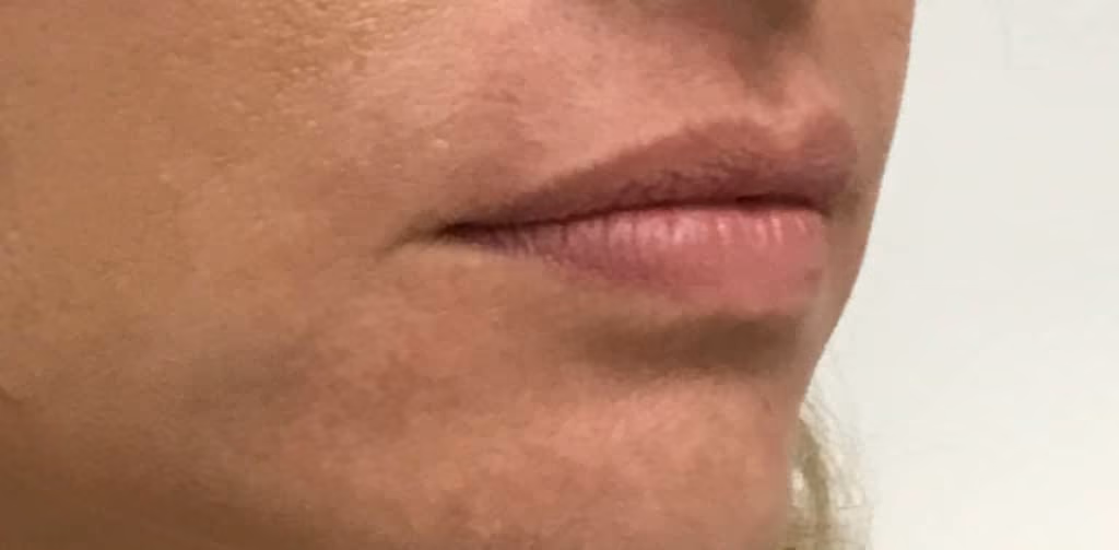 Filler before and after, case 18693 - Cool Springs Plastic Surgery