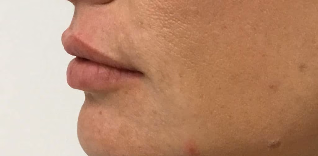 Filler before and after, case 18693 - Cool Springs Plastic Surgery
