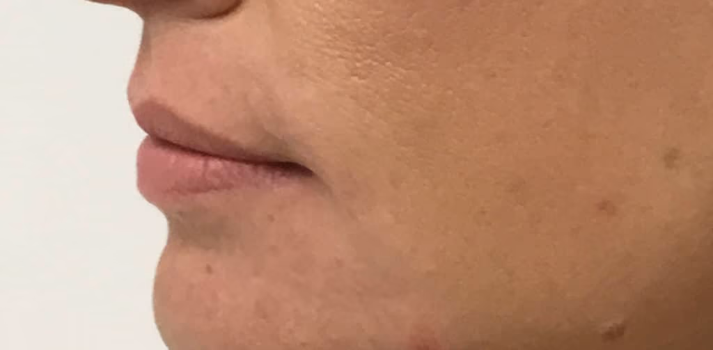 Filler before and after, case 18693 - Cool Springs Plastic Surgery