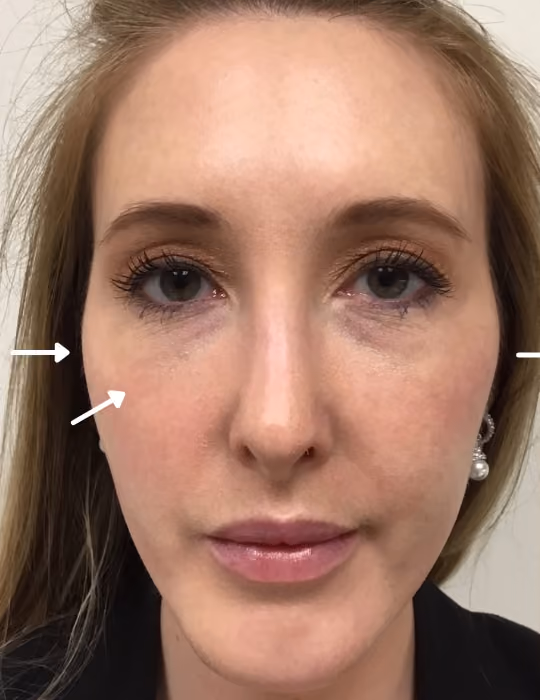 Filler before and after, case 18703 - Cool Springs Plastic Surgery
