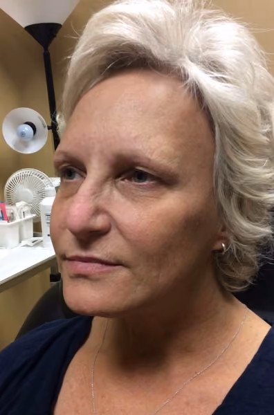 Filler before and after, case 2184 - Cool Springs Plastic Surgery