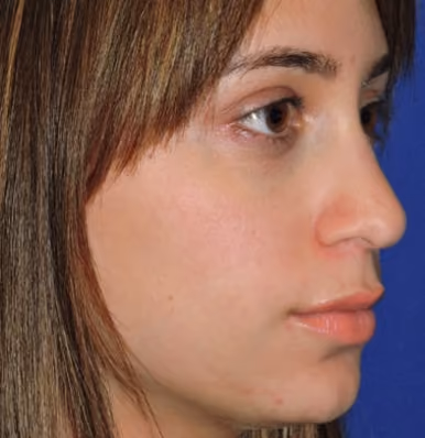Filler before and after, case 2198 - Cool Springs Plastic Surgery