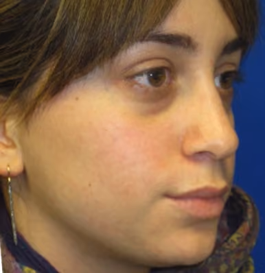 Filler before and after, case 2198 - Cool Springs Plastic Surgery