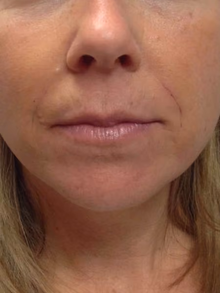 Filler before and after, case 2215 - Cool Springs Plastic Surgery