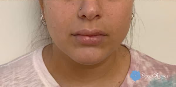 Filler before and after, case 22665 - Cool Springs Plastic Surgery