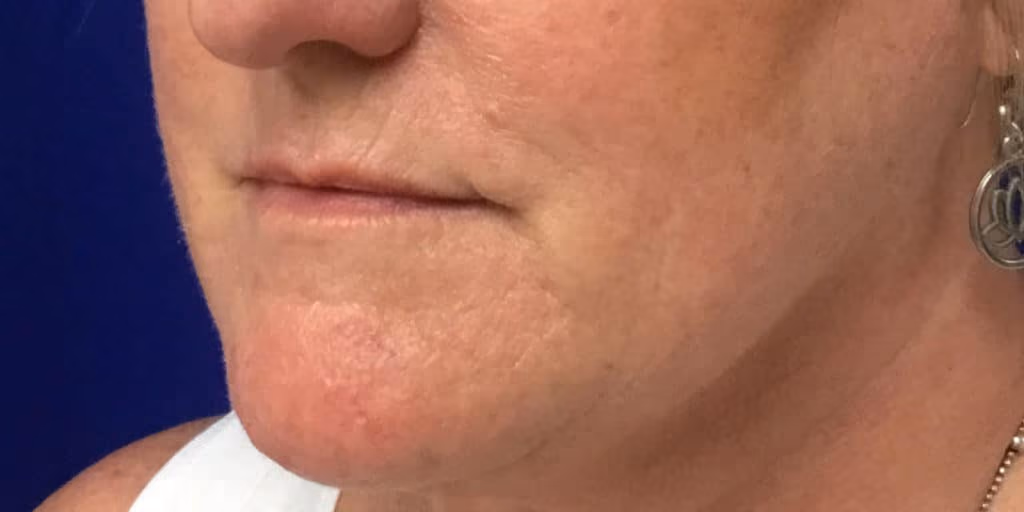 Filler before and after, case 22675 - Cool Springs Plastic Surgery