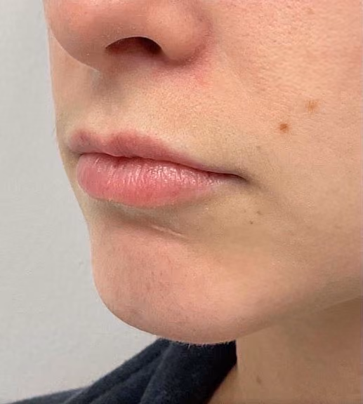 Filler before and after, case 23815 - Cool Springs Plastic Surgery