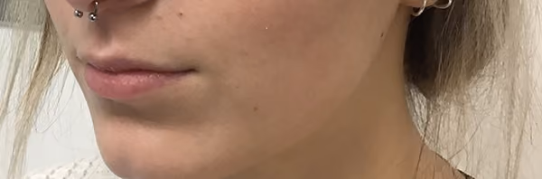 Filler before and after, case 23920 - Cool Springs Plastic Surgery