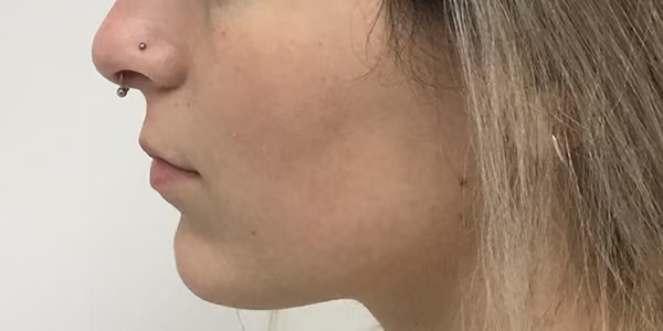 Filler before and after, case 23920 - Cool Springs Plastic Surgery