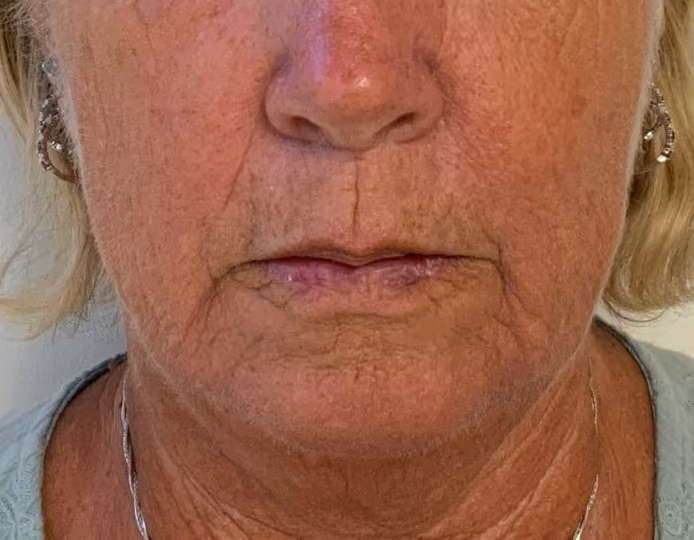 Filler before and after, case 26316 - Cool Springs Plastic Surgery