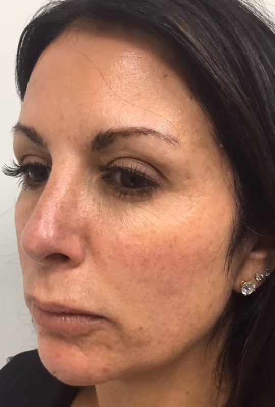 Filler before and after, case 26581 - Cool Springs Plastic Surgery
