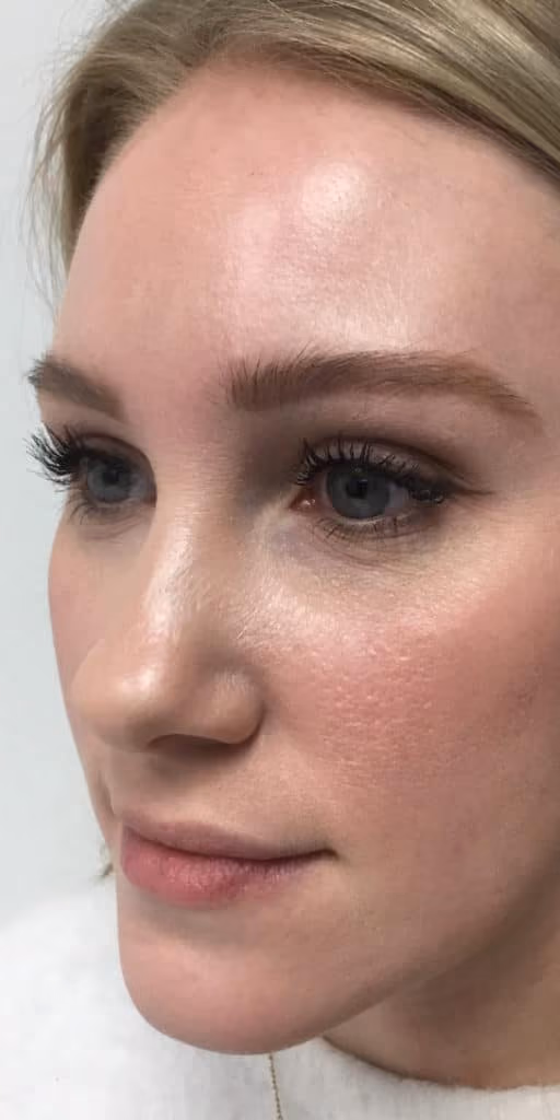 Filler before and after, case 26611 - Cool Springs Plastic Surgery