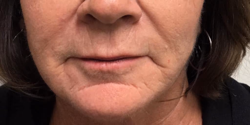 Filler before and after, case 6968 - Cool Springs Plastic Surgery