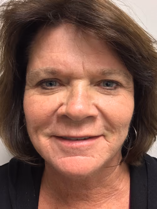 Filler before and after, case 6968 - Cool Springs Plastic Surgery