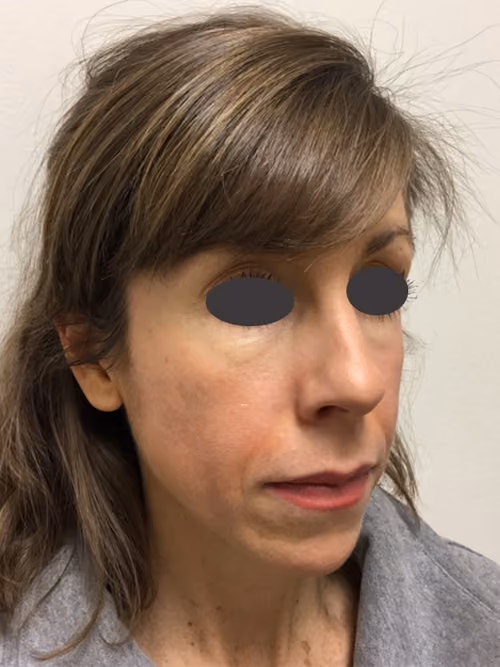 Filler before and after, case 6984 - Cool Springs Plastic Surgery