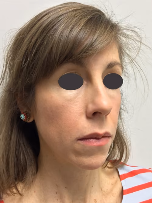 Filler before and after, case 6984 - Cool Springs Plastic Surgery