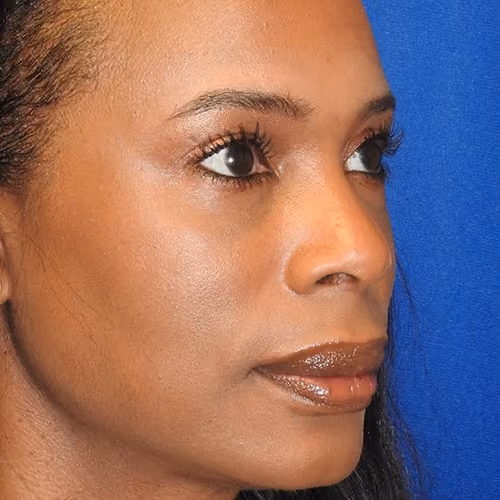 Filler before and after, case 8926 - Cool Springs Plastic Surgery