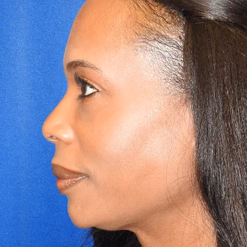 Filler before and after, case 8926 - Cool Springs Plastic Surgery