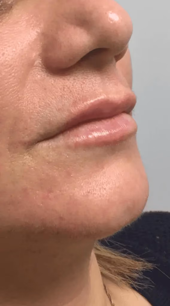 Filler before and after, case 9528 - Cool Springs Plastic Surgery