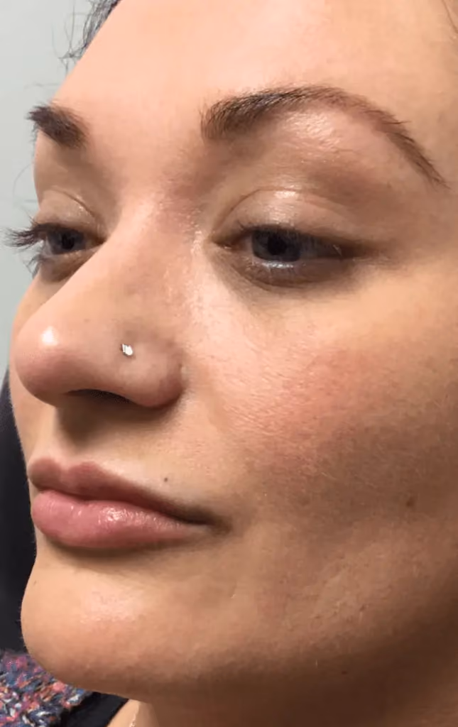 Filler before and after, case 9534 - Cool Springs Plastic Surgery