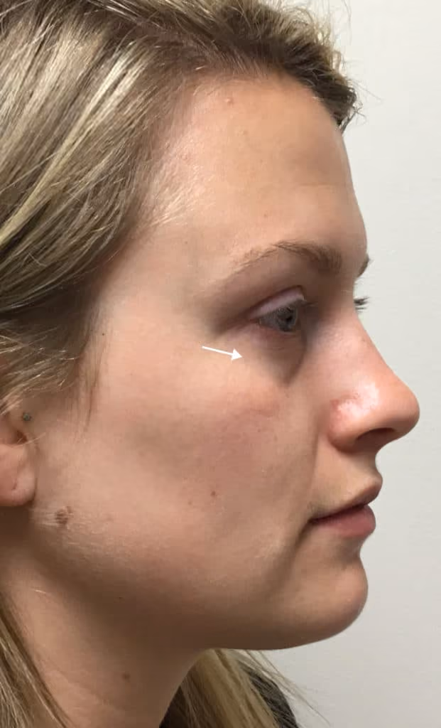 Filler before and after, case 9750 - Cool Springs Plastic Surgery