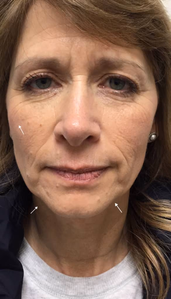 Filler before and after, case 9768 - Cool Springs Plastic Surgery