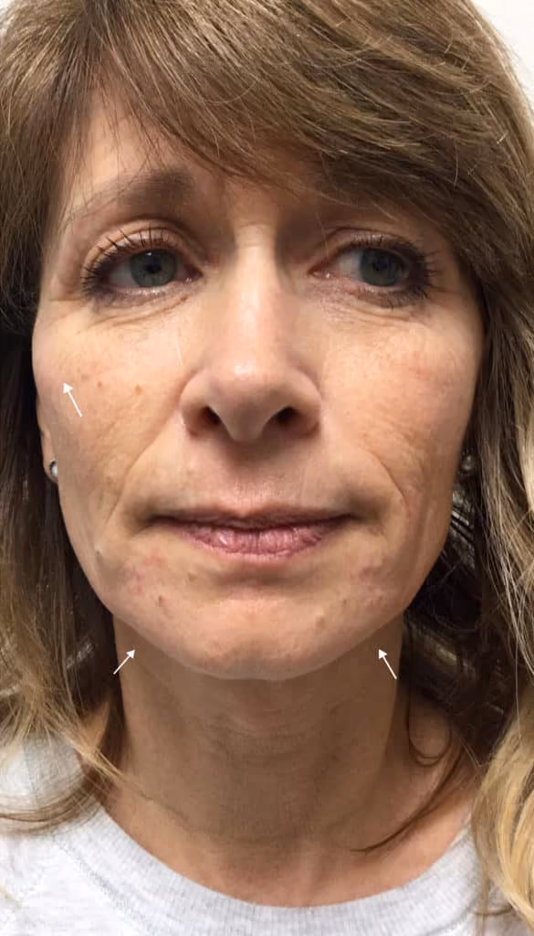 Filler before and after, case 9768 - Cool Springs Plastic Surgery