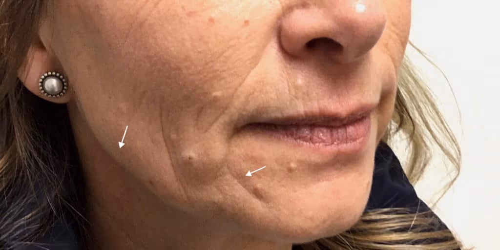 Filler before and after, case 9768 - Cool Springs Plastic Surgery