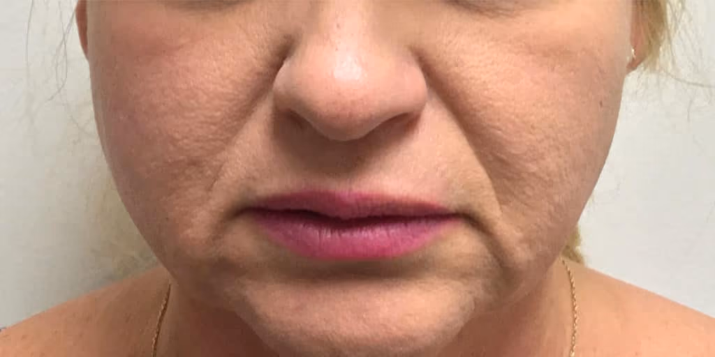Filler before and after, case 9776 - Cool Springs Plastic Surgery