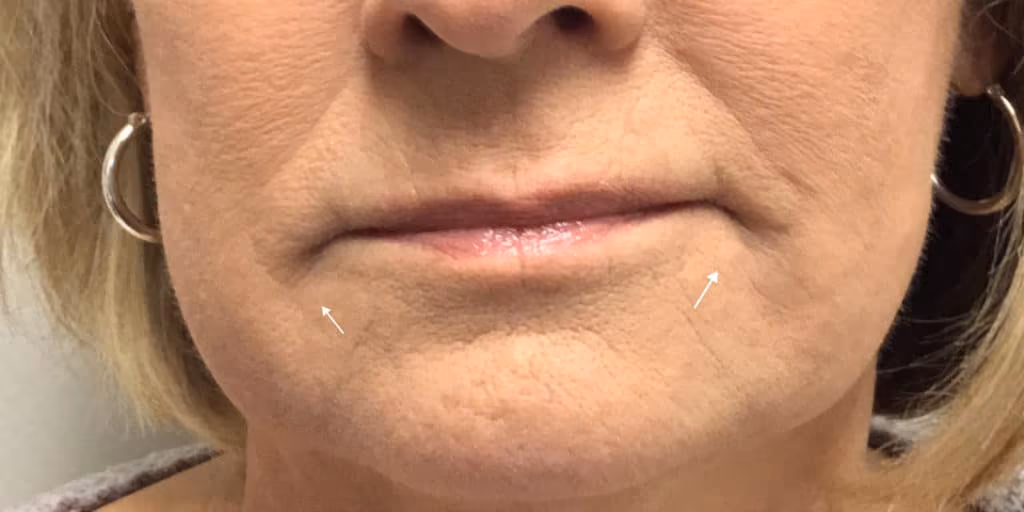 Filler before and after, case 9893 - Cool Springs Plastic Surgery