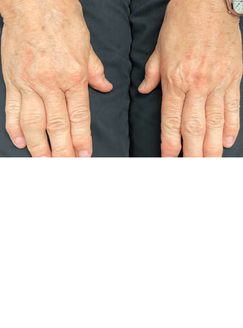 Filler before and after, case 11656 - Cool Springs Plastic Surgery