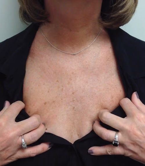 Medical-Grade Skincare before and after, case 4438 - Cool Springs Plastic Surgery