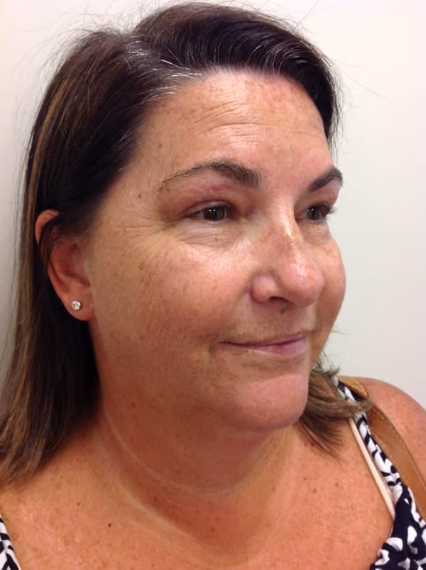 Medical-Grade Skincare before and after, case 6359 - Cool Springs Plastic Surgery