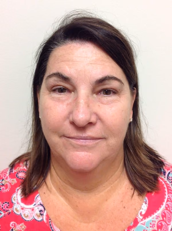 Medical-Grade Skincare before and after, case 6359 - Cool Springs Plastic Surgery