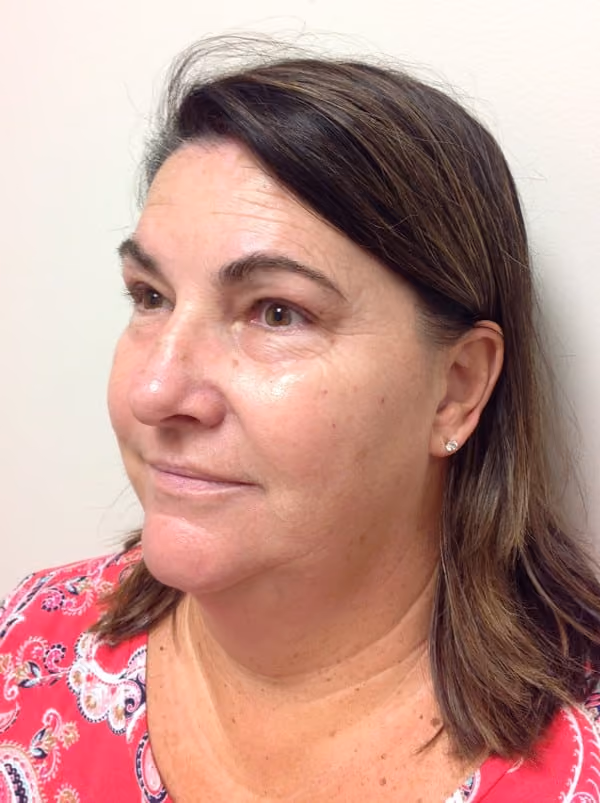 Medical-Grade Skincare before and after, case 6359 - Cool Springs Plastic Surgery