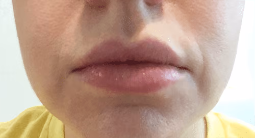 Medical-Grade Skincare before and after, case 6871 - Cool Springs Plastic Surgery