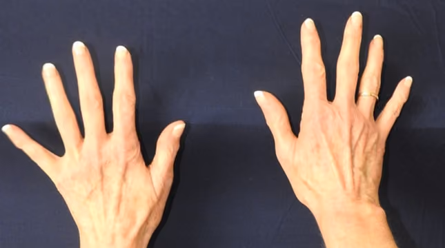 Hand Rejuvenation before and after, case 13400 - Cool Springs Plastic Surgery