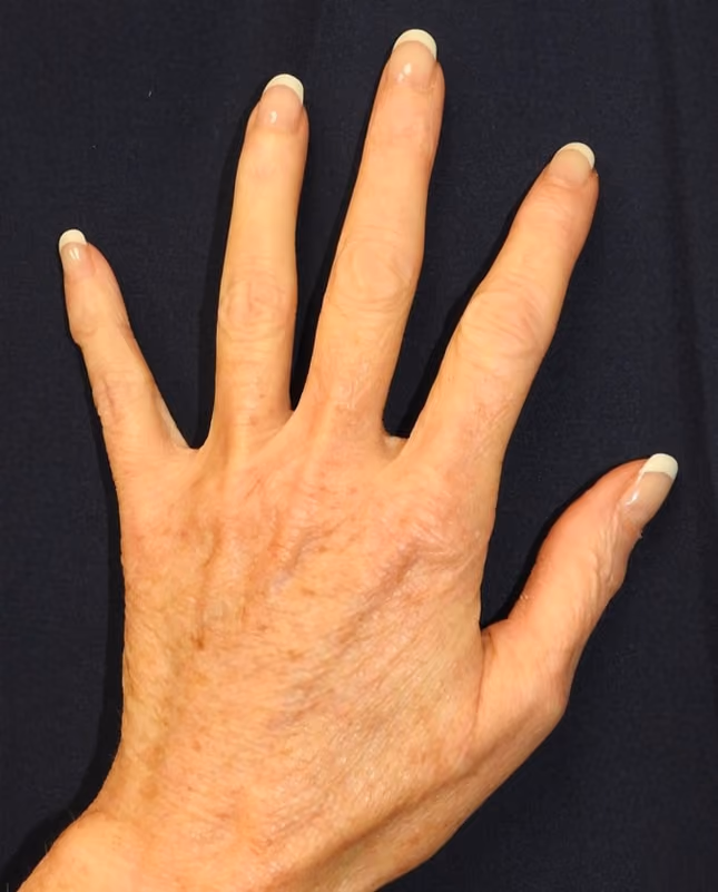 Hand Rejuvenation before and after, case 13400 - Cool Springs Plastic Surgery